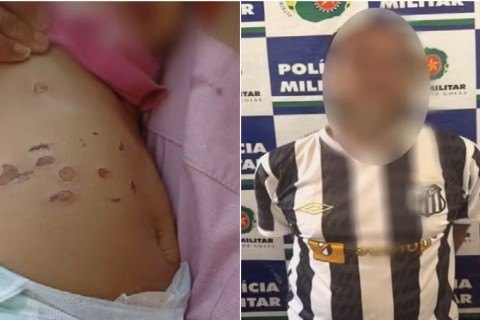 Bebê de 10 meses é hospitalizada com queimaduras de cigarro em caso de possível tortura