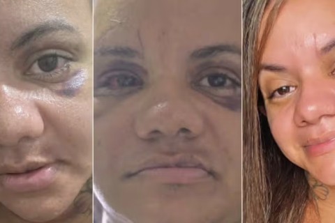Agredida com 61 socos, Juliana Garcia compartilha recuperação e emociona ao mostrar cada passo da reconstrução facial